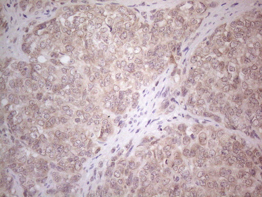 ABCC5 / MRP5 Antibody - Immunohistochemical staining of paraffin-embedded Adenocarcinoma of Human endometrium tissue using anti-ABCC5 mouse monoclonal antibody. (Heat-induced epitope retrieval by 1mM EDTA in 10mM Tris buffer. (pH8.5) at 120°C for 3 min. (1:150)