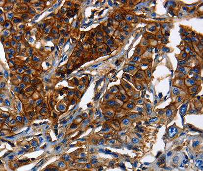 ABCC5 / MRP5 Antibody - Immunohistochemistry of paraffin-embedded Human lung cancer tissue using ABCC5 antibody.