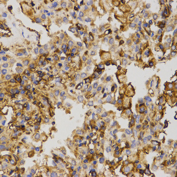 ABCC5 / MRP5 Antibody - Immunohistochemistry of paraffin-embedded human lung cancer tissue using ABCC5 antibody at dilution of 1:200 (x400 lens).