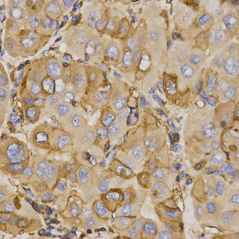 ABCC5 / MRP5 Antibody - Immunohistochemistry of paraffin-embedded human liver cancer tissue using ABCC5 antibody at dilution of 1:200 (x400 lens)