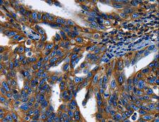 ABCC5 / MRP5 Antibody - Immunohistochemistry of paraffin-embedded Human ovarian cancer using ABCC5 Polyclonal Antibody at dilution of 1:50.