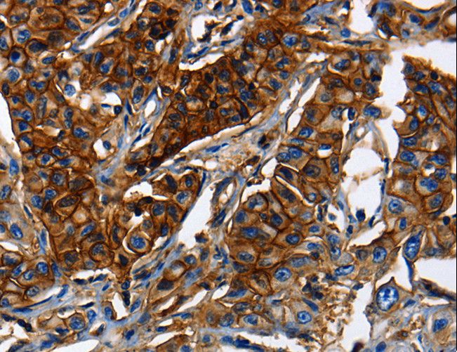 ABCC5 / MRP5 Antibody - Immunohistochemistry of paraffin-embedded Human lung cancer using ABCC5 Polyclonal Antibody at dilution of 1:50.