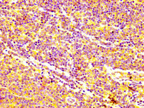 ABCC5 / MRP5 Antibody - Immunohistochemistry image at a dilution of 1:400 and staining in paraffin-embedded human lymph node tissue performed on a Leica BondTM system. After dewaxing and hydration, antigen retrieval was mediated by high pressure in a citrate buffer (pH 6.0) . Section was blocked with 10% normal goat serum 30min at RT. Then primary antibody (1% BSA) was incubated at 4 °C overnight. The primary is detected by a biotinylated secondary antibody and visualized using an HRP conjugated SP system.