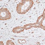 ABCC5 / MRP5 Antibody - Immunohistochemistry of paraffin-embedded Human breast cancer using ABCC5 Polyclonal Antibody at dilution of 1:100 (40x lens).