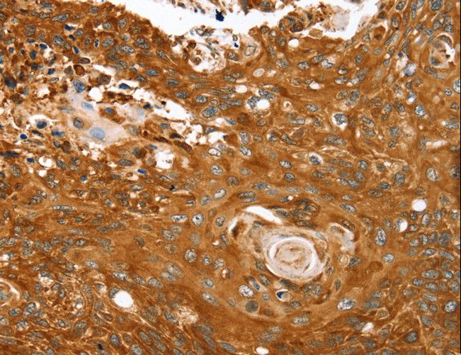 ABCC8 / SUR1 Antibody - Immunohistochemistry of paraffin-embedded Human esophagus cancer using ABCC8 Polyclonal Antibody at dilution of 1:40.