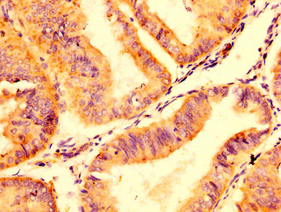 ABCC8 / SUR1 Antibody - Immunohistochemistry image at a dilution of 1:500 and staining in paraffin-embedded human endometrial cancer performed on a Leica BondTM system. After dewaxing and hydration, antigen retrieval was mediated by high pressure in a citrate buffer (pH 6.0) . Section was blocked with 10% normal goat serum 30min at RT. Then primary antibody (1% BSA) was incubated at 4 °C overnight. The primary is detected by a biotinylated secondary antibody and visualized using an HRP conjugated SP system.