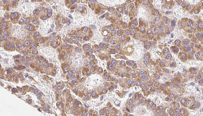 ABCC8 / SUR1 Antibody - 1:100 staining human liver carcinoma tissues by IHC-P. The sample was formaldehyde fixed and a heat mediated antigen retrieval step in citrate buffer was performed. The sample was then blocked and incubated with the antibody for 1.5 hours at 22°C. An HRP conjugated goat anti-rabbit antibody was used as the secondary.