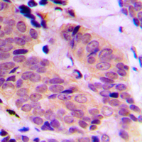 ABCD4 Antibody - Immunohistochemical analysis of ABCD4 staining in human breast cancer formalin fixed paraffin embedded tissue section. The section was pre-treated using heat mediated antigen retrieval with sodium citrate buffer (pH 6.0). The section was then incubated with the antibody at room temperature and detected using an HRP conjugated compact polymer system. DAB was used as the chromogen. The section was then counterstained with hematoxylin and mounted with DPX.