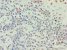 ABCE1 Antibody - Immunohistochemistry of paraffin-embedded human breast cancer using antibody at 1:100 dilution.
