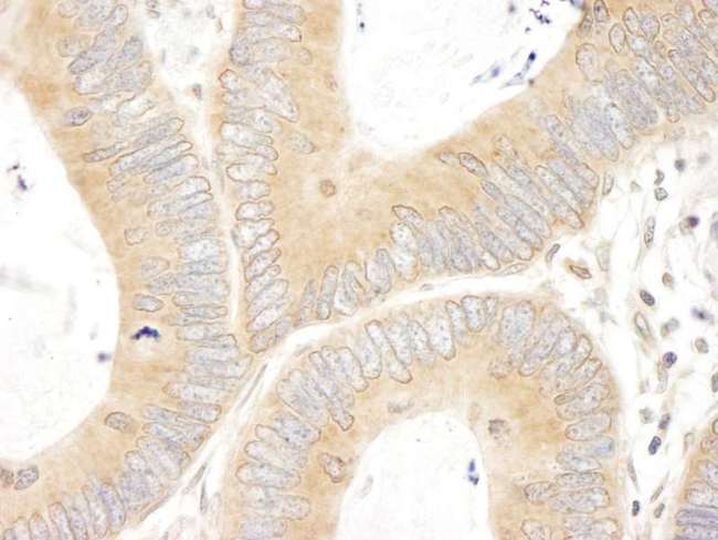 ABCF1 Antibody - Detection of Human ABC50 by Immunohistochemistry. Sample: FFPE section of human colon carcinoma. Antibody: Affinity purified rabbit anti-ABC50 used at a dilution of 1:200 (1 ug/ml).