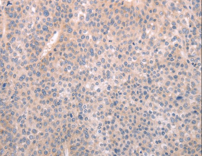 ABCF1 Antibody - Immunohistochemistry of paraffin-embedded Human liver cancer using ABCF1 Polyclonal Antibody at dilution of 1:40.