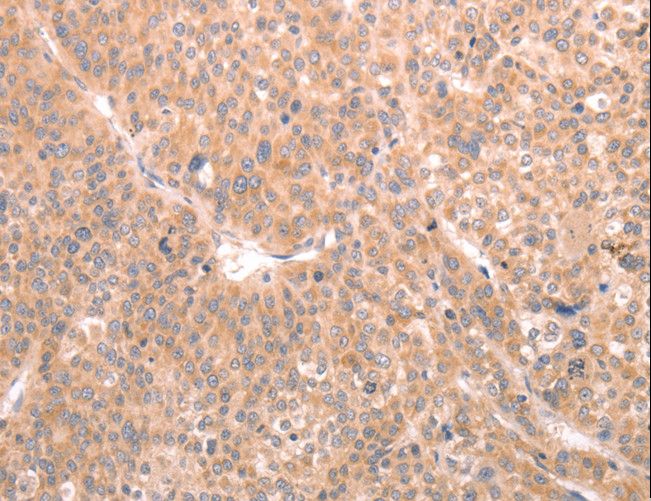 ABCF1 Antibody - Immunohistochemistry of paraffin-embedded Human liver cancer using ABCF1 Polyclonal Antibody at dilution of 1:40.