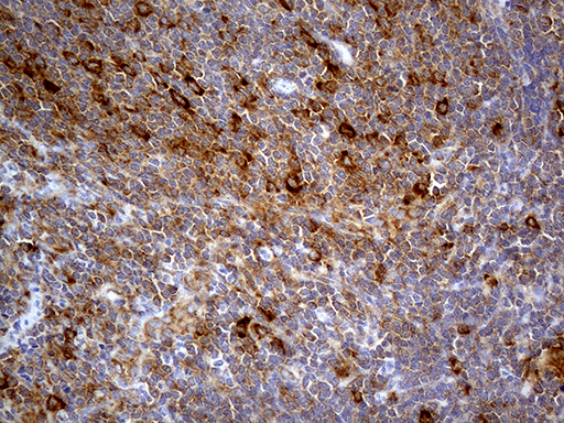 ABCF2 Antibody - Immunohistochemical staining of paraffin-embedded Human lymphoma tissue using anti-ABCF2 mouse monoclonal antibody. (Heat-induced epitope retrieval by 1mM EDTA in 10mM Tris buffer. (pH8.5) at 120°C for 3 min. (1:500)