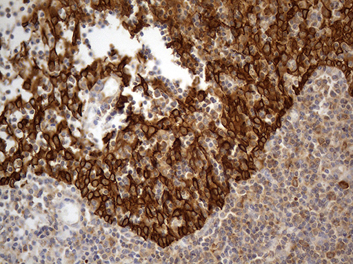ABCF2 Antibody - Immunohistochemical staining of paraffin-embedded Human tonsil within the normal limits using anti-ABCF2 mouse monoclonal antibody. (Heat-induced epitope retrieval by 1mM EDTA in 10mM Tris buffer. (pH8.5) at 120°C for 3 min. (1:500)