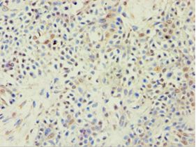 ABCF2 Antibody - Immunohistochemistry of paraffin-embedded human breast cancer using antibody at 1:100 dilution.