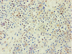 ABCF2 Antibody - Immunohistochemistry of paraffin-embedded human breast cancer using ABCF2 Antibody at dilution of 1:100