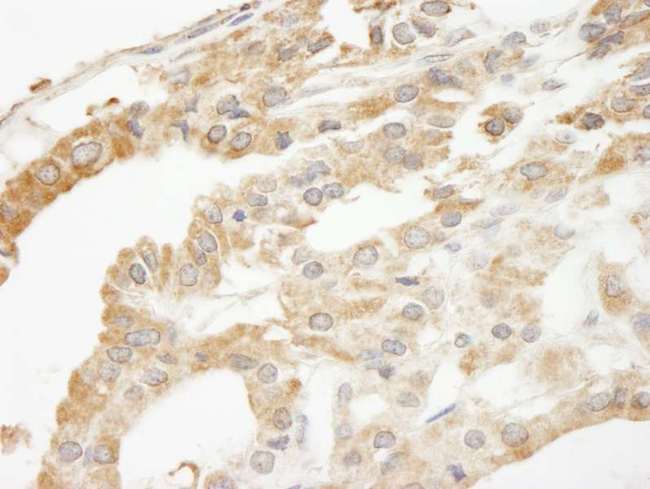 ABCF2 Antibody - Detection of Human ABCF2 by Immunohistochemistry. Sample: FFPE section of human thyroid carcinoma. Antibody: Affinity purified rabbit anti-ABCF2 used at a dilution of 1:250.