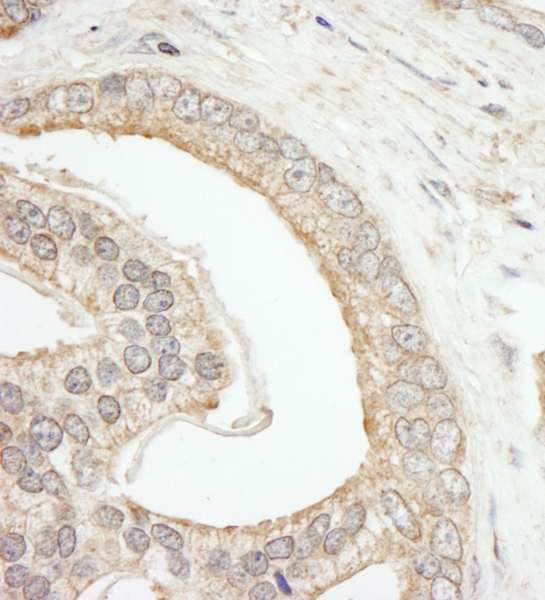 ABCF2 Antibody - Detection of Human ABCF2 by Immunohistochemistry. Sample: FFPE section of human prostate carcinoma. Antibody: Affinity purified rabbit anti-ABCF2 used at a dilution of 1:1000 (1 ug/ml).