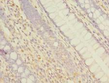 ABCF3 Antibody - Immunohistochemistry of paraffin-embedded human colon cancer using antibody at dilution of 1:100.