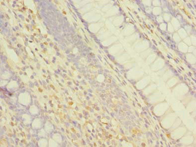 ABCF3 Antibody - Immunohistochemistry of paraffin-embedded human colon cancer using ABCF3 Antibody at dilution of 1:100