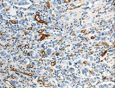 ABCG1 Antibody - Immunohistochemistry of paraffin-embedded Human gastric cancer using ABCG1 Polyclonal Antibody at dilution of 1:40.