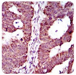 ABCG5 Antibody - Immunohistochemistry: ABCG5 Antibody (1B5E10) - IHC analysis of paraffin-embedded rectum cancer tissues using ABCG5 mouse mAb with DAB staining.  This image was taken for the unconjugated form of this product. Other forms have not been tested.