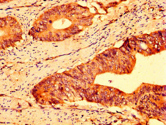 ABCG5 Antibody - Immunohistochemistry image at a dilution of 1:500 and staining in paraffin-embedded human colon cancer performed on a Leica BondTM system. After dewaxing and hydration, antigen retrieval was mediated by high pressure in a citrate buffer (pH 6.0) . Section was blocked with 10% normal goat serum 30min at RT. Then primary antibody (1% BSA) was incubated at 4 °C overnight. The primary is detected by a biotinylated secondary antibody and visualized using an HRP conjugated SP system.