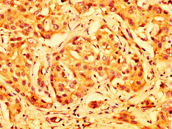 ABCG5 Antibody - Immunohistochemistry image at a dilution of 1:500 and staining in paraffin-embedded human liver cancer performed on a Leica BondTM system. After dewaxing and hydration, antigen retrieval was mediated by high pressure in a citrate buffer (pH 6.0) . Section was blocked with 10% normal goat serum 30min at RT. Then primary antibody (1% BSA) was incubated at 4 °C overnight. The primary is detected by a biotinylated secondary antibody and visualized using an HRP conjugated SP system.
