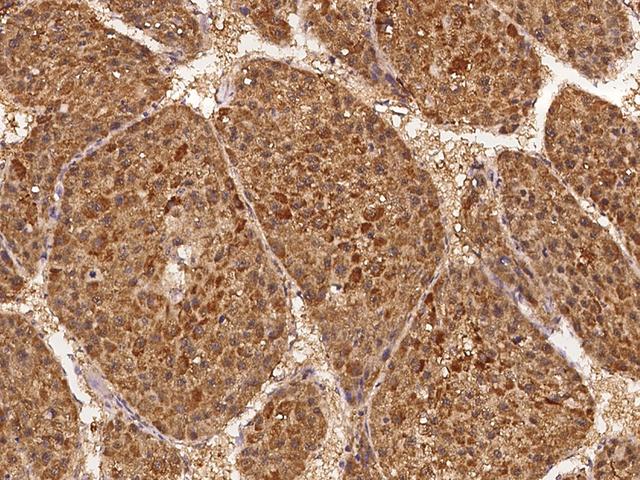 ABCG5 Antibody - Immunochemical staining of human ABCG5 in human hepatoma with rabbit polyclonal antibody at 1:100 dilution, formalin-fixed paraffin embedded sections.