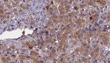 ABCG8 Antibody - 1:100 staining human liver carcinoma tissues by IHC-P. The sample was formaldehyde fixed and a heat mediated antigen retrieval step in citrate buffer was performed. The sample was then blocked and incubated with the antibody for 1.5 hours at 22°C. An HRP conjugated goat anti-rabbit antibody was used as the secondary.