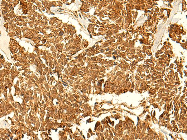 ABHD10 Antibody - Immunohistochemistry of paraffin-embedded Human lung cancer tissue  using ABHD10 Polyclonal Antibody at dilution of 1:50(×200)