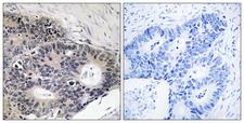 ABHD12B Antibody - Peptide - + Immunohistochemistry analysis of paraffin-embedded human colon carcinoma tissue using ABHD12B antibody.