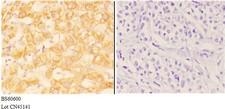 ABHD13 Antibody - Immunohistochemistry (IHC) analysis of ABHD13 antibody in paraffin-embedded human liver carcinoma tissue at 1:50, showing cytoplasmic and membrane staining. Negative control (the right) using PBS instead of primary antibody. Secondary antibody is Goat Anti-Rabbit.