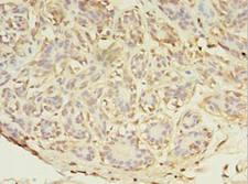 ABHD14A Antibody - Immunohistochemistry of paraffin-embedded human breast cancer using antibody at 1:100 dilution.