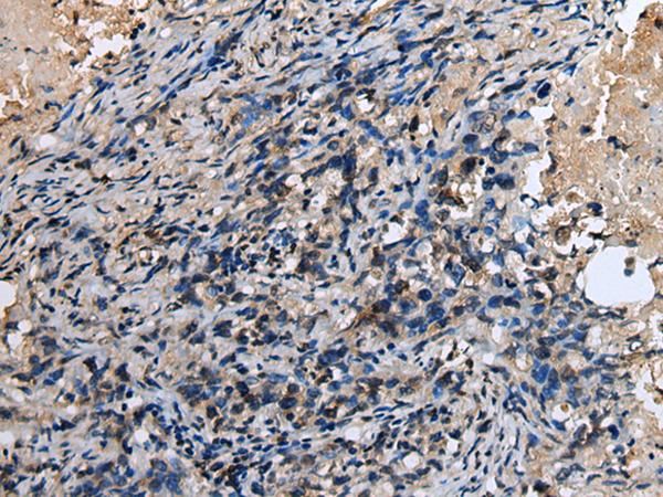 ABHD14B Antibody - Immunohistochemistry of paraffin-embedded Human lung cancer tissue  using ABHD14B Polyclonal Antibody at dilution of 1:30(×200)
