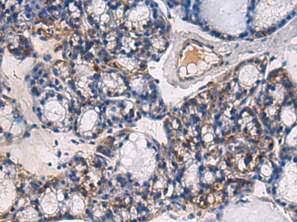 ABHD14B Antibody - Immunohistochemistry of paraffin-embedded Human thyroid cancer tissue  using ABHD14B Polyclonal Antibody at dilution of 1:60(×200)
