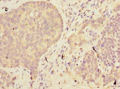 ABHD2 Antibody - Immunohistochemistry of paraffin-embedded human gastric cancer using antibody at dilution of 1:100.