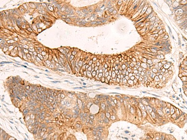 ABHD2 Antibody - Immunohistochemistry of paraffin-embedded Human colorectal cancer tissue  using ABHD2 Polyclonal Antibody at dilution of 1:50(×200)