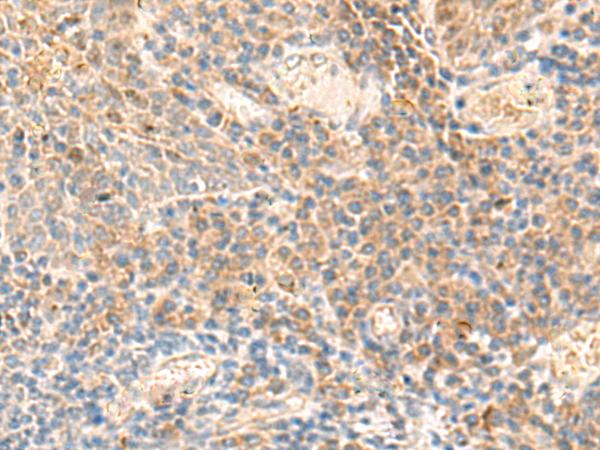 ABHD2 Antibody - Immunohistochemistry of paraffin-embedded Human tonsil tissue  using ABHD2 Polyclonal Antibody at dilution of 1:50(×200)