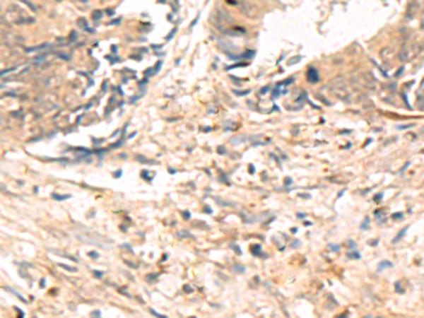 ABHD2 Antibody - Immunohistochemistry of paraffin-embedded Human colorectal cancer tissue  using ABHD2 Polyclonal Antibody at dilution of 1:40(×200)