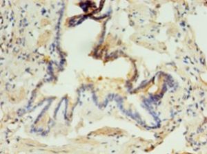 ABHD3 Antibody - Immunohistochemistry of paraffin-embedded human lung tissue using antibody at 1:100 dilution.  This image was taken for the unconjugated form of this product. Other forms have not been tested.