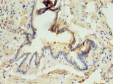 ABHD3 Antibody - Immunohistochemistry of paraffin-embedded human lung tissue using antibody at 1:100 dilution.  This image was taken for the unconjugated form of this product. Other forms have not been tested.