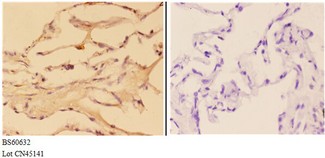 ABHD3 Antibody - Immunohistochemistry (IHC) analysis of ABHD3 antibody in paraffin-embedded human lung carcinoma tissue at 1:50, showing cytoplasmic and membrane staining. Negative control (the right) using PBS instead of primary antibody. Secondary antibody is Goat Anti-Rabbit I.