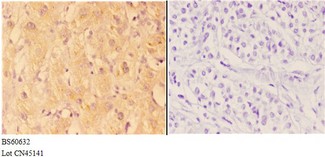 ABHD3 Antibody - Immunohistochemistry (IHC) analysis of ABHD3 antibody in paraffin-embedded human liver carcinoma tissue at 1:50, showing cytoplasmic and membrane staining. Negative control (the right) using PBS instead of primary antibody. Secondary antibody is Goat Anti-Rabbit.