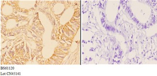 ABHD4 Antibody - Immunohistochemistry (IHC) analysis of ABHD4 antibody in paraffin-embedded human rectum carcinoma tissue at 1:50, showing cytoplasmic and membrane staining. Negative control (the right) using PBS instead of primary antibody. Secondary antibody is Goat Anti-Rabbit.