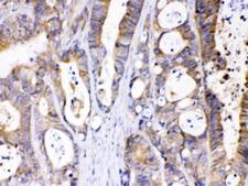ABHD5 Antibody - IHC testing of FFPE human intestinal cancer tissue with ABHD5 antibody at 1 ug/ml. HIER: steam sections in pH6 citrate buffer for 20 min.