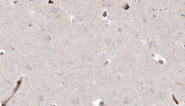 ABHD5 Antibody - 1:100 staining human brain carcinoma tissue by IHC-P. The sample was formaldehyde fixed and a heat mediated antigen retrieval step in citrate buffer was performed. The sample was then blocked and incubated with the antibody for 1.5 hours at 22°C. An HRP conjugated goat anti-rabbit antibody was used as the secondary.