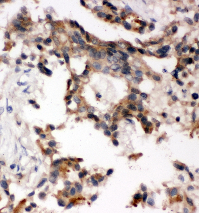 ABI1 / SSH3BP1 Antibody - IHC analysis of ABI using anti-ABI antibody. ABI was detected in paraffin-embedded section of human lung cancer tissues. Heat mediated antigen retrieval was performed in citrate buffer (pH6, epitope retrieval solution) for 20 mins. The tissue section was blocked with 10% goat serum. The tissue section was then incubated with 1µg/ml rabbit anti-ABI Antibody overnight at 4°C. Biotinylated goat anti-rabbit IgG was used as secondary antibody and incubated for 30 minutes at 37°C. The tissue section was developed using Strepavidin-Biotin-Complex (SABC) with DAB as the chromogen.