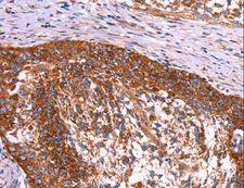 ABI1 / SSH3BP1 Antibody - Immunohistochemistry of paraffin-embedded Human cervical cancer using ABI1 Polyclonal Antibody at dilution of 1:40.
