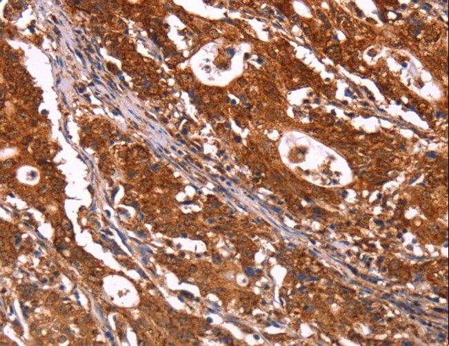 ABI1 / SSH3BP1 Antibody - Immunohistochemistry of paraffin-embedded Human gastric cancer using ABI1 Polyclonal Antibody at dilution of 1:40.